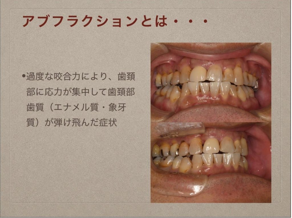 歯周病/むし歯/トゥースウェアー/歯磨き粉